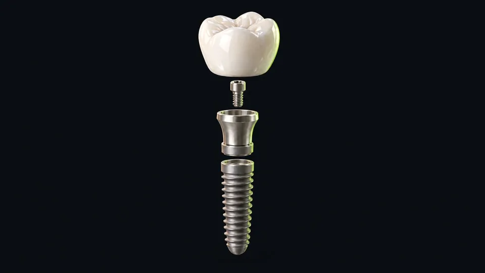 A dental implant taken apart: the porcelain crown, the abutment screw, the titanium abutment and the threaded implant.